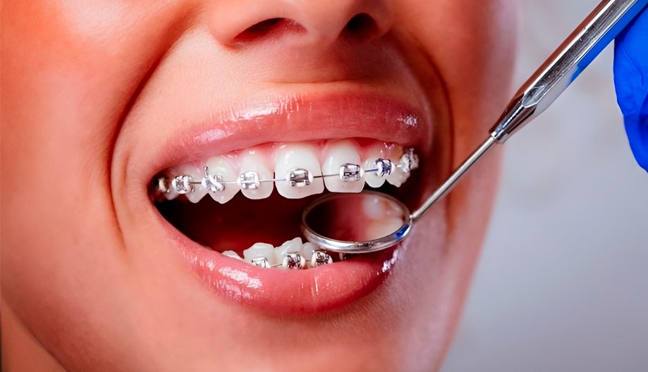 ¿Carillas o Blanqueamiento dental? Cómo elegir el tratamiento ideal para tu sonrisa